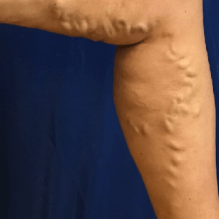 vericose veins